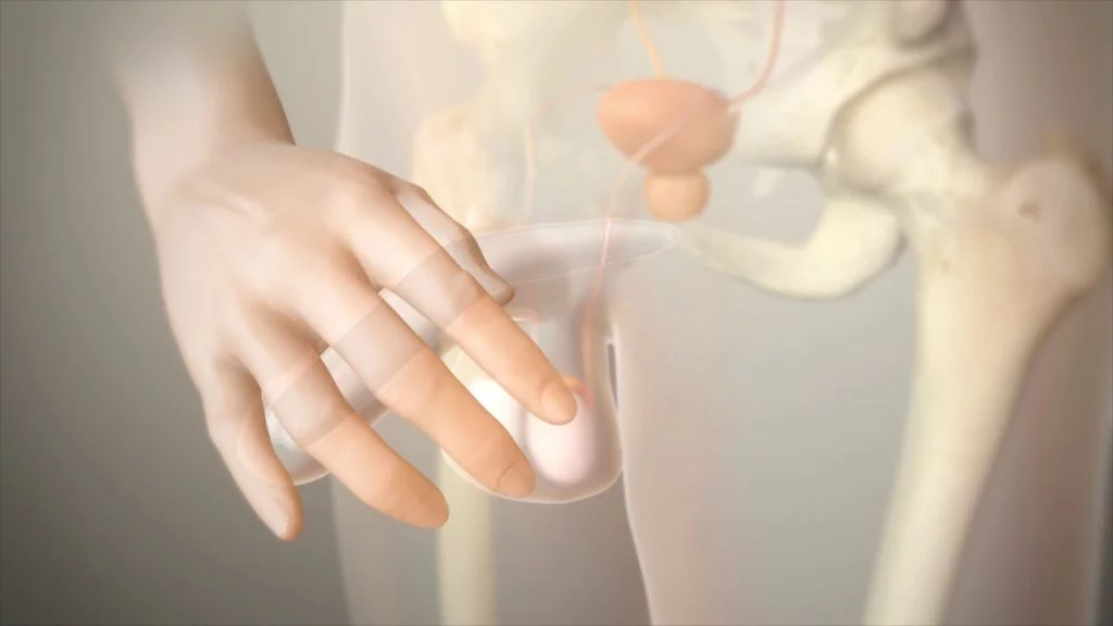Inflatable three-piece penile implant components