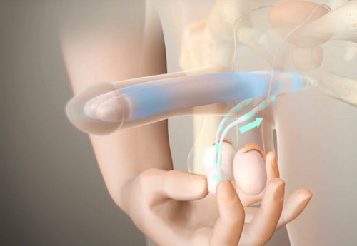 Malleable (semi-rigid) penile implant overview