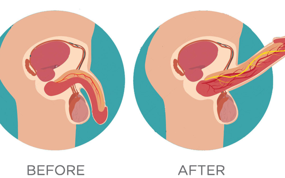 Dermal filler-based penile girth augmentation